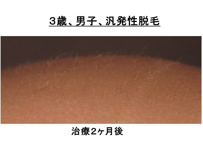 円形脱毛症　名医""